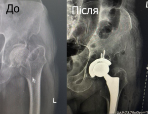 Заміна кульшового суглоба, пацієнт Куліш, до і після операції