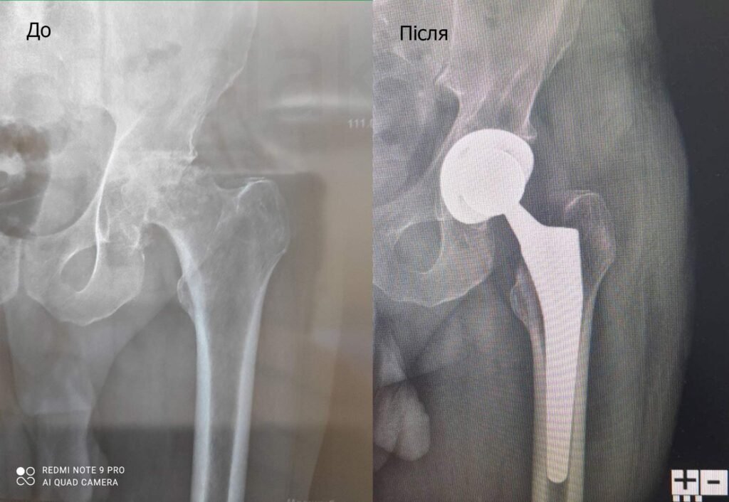 Заміна кульшового суглоба: порівняння до і після