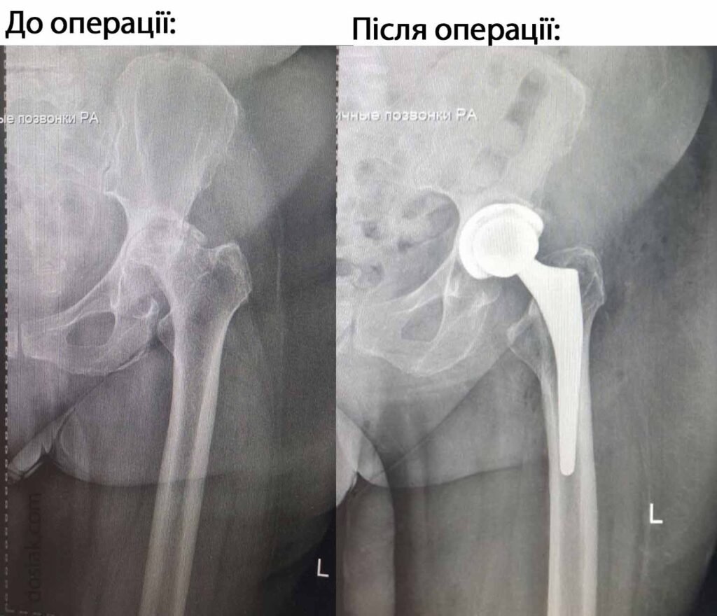 Рентген до і після операції по ендопротезуванню кульшового суглоба