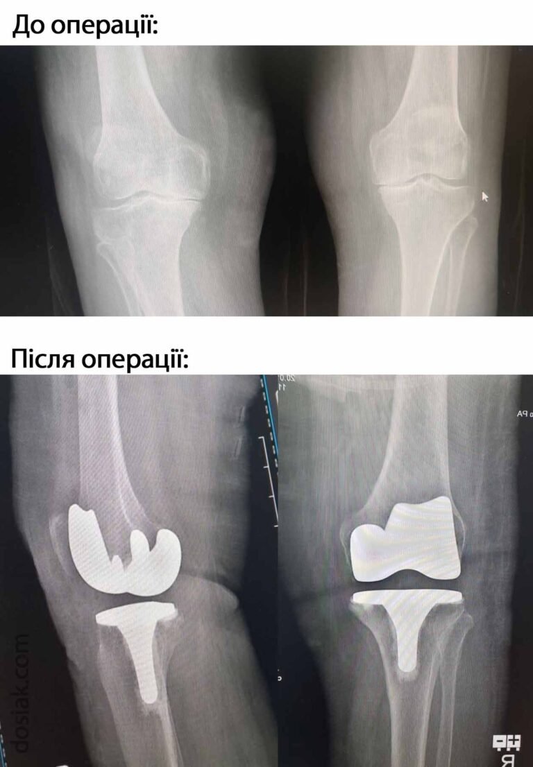 Рентген до і після операції по заміні колінного суглоба