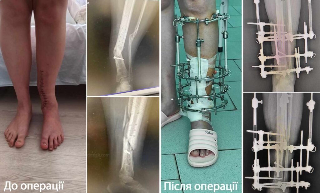 Лікування незрощення кістки — Романчук Алла