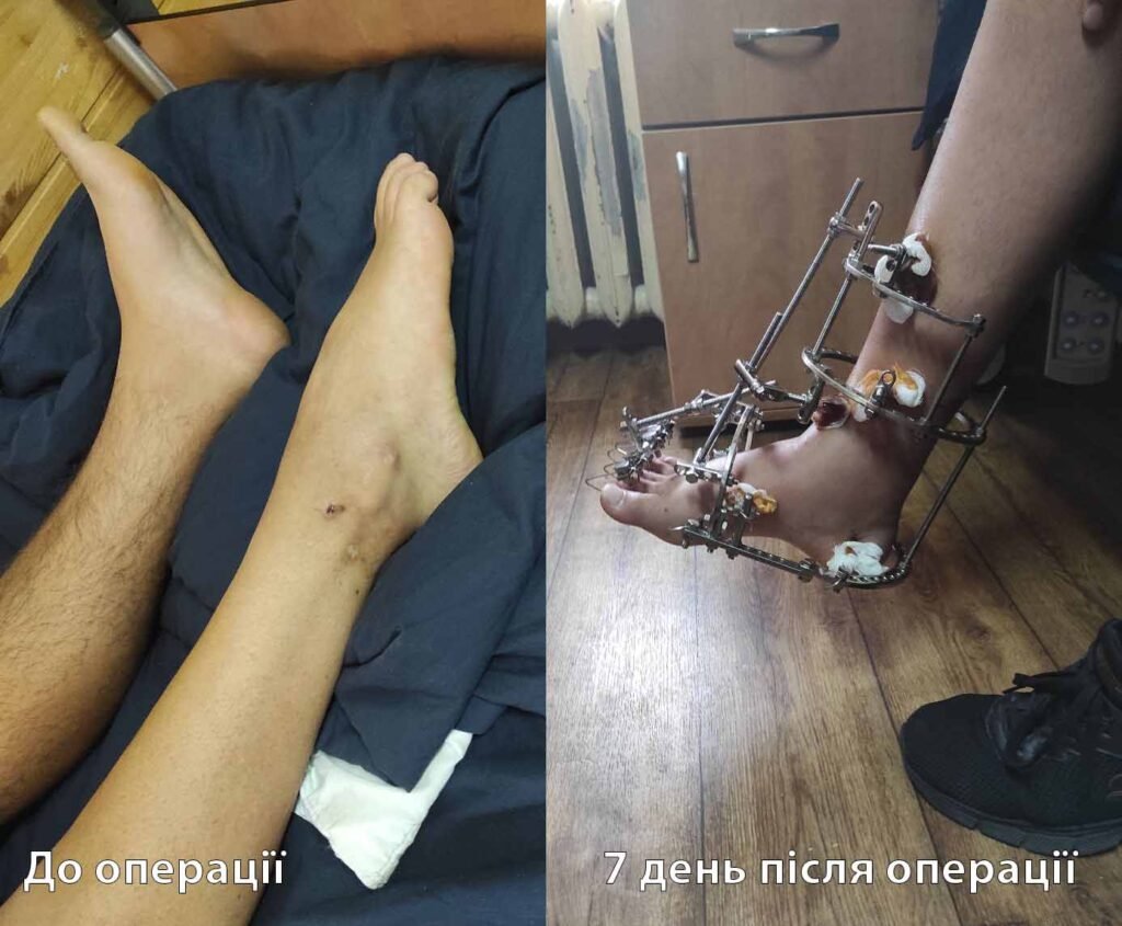 Лікування бойової травми — Сергій