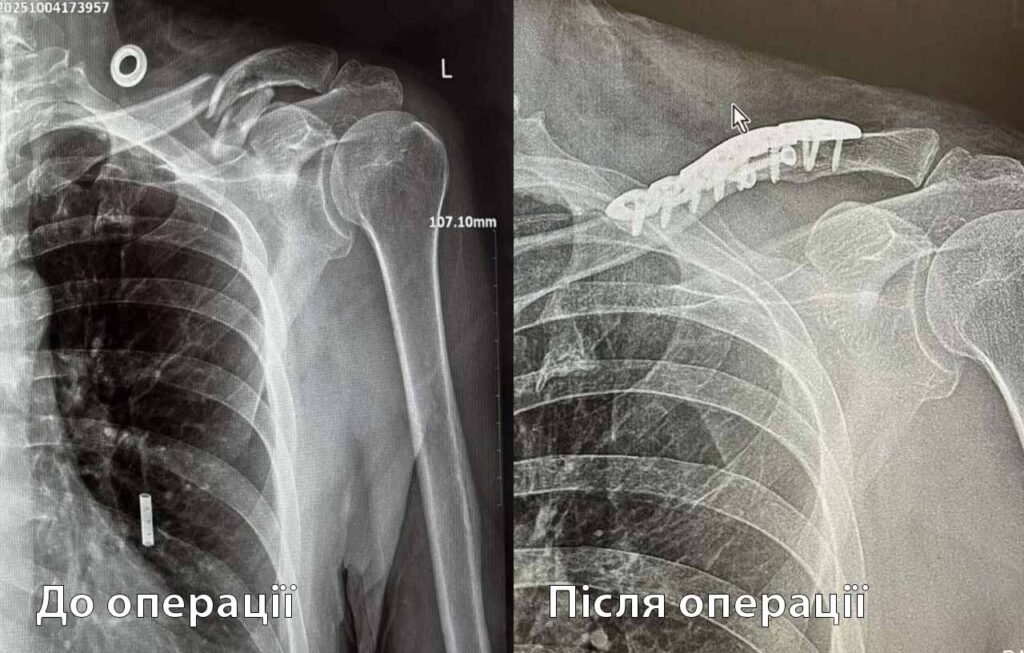 перелом ключиці