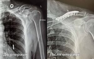 перелом ключиці